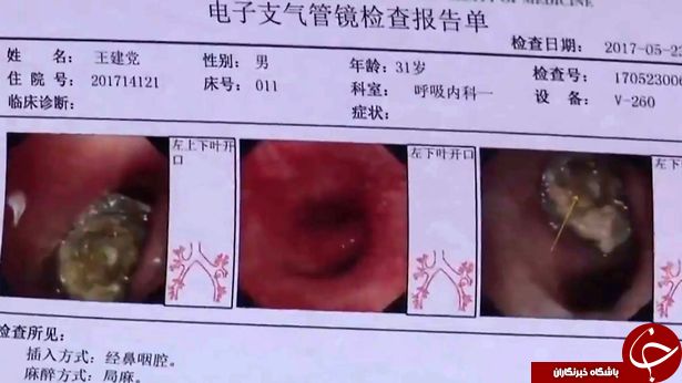 پیدا شدن کلاهک خودکار در ریه بیمار بعد از 20 سال +تصاویر