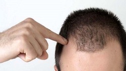 راهکار‌هایی برای جلوگیری از ریزش مو در آقایان