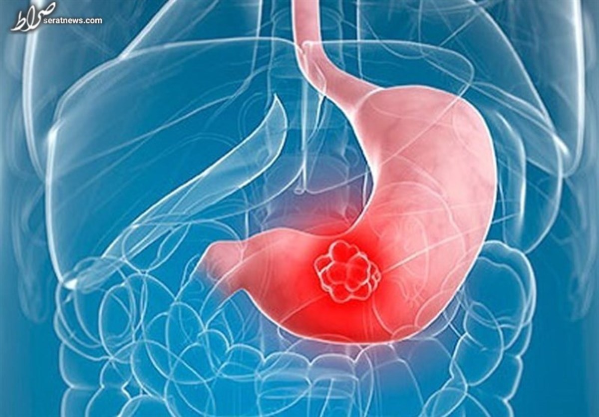 شیوع سونامی سرطان گوارش در مازندران