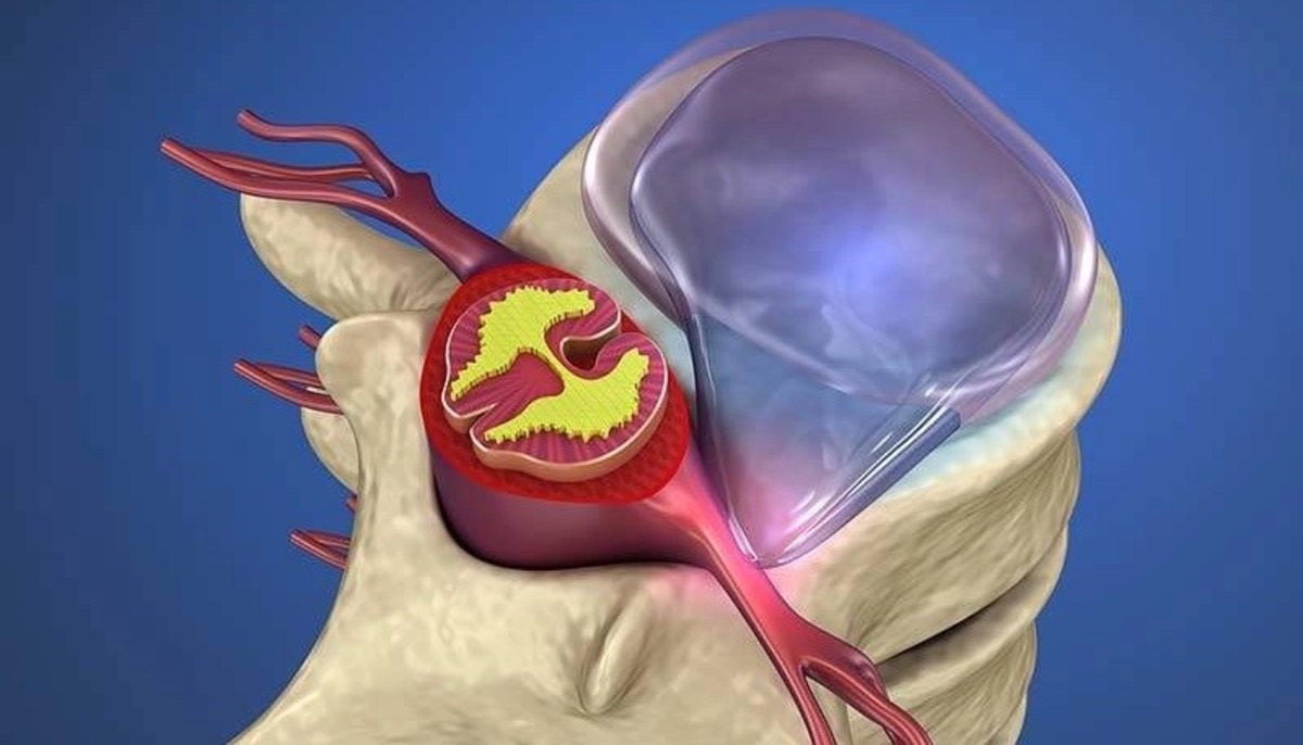 درمان دیسک کمر: از درمان خانگی تا جراحی