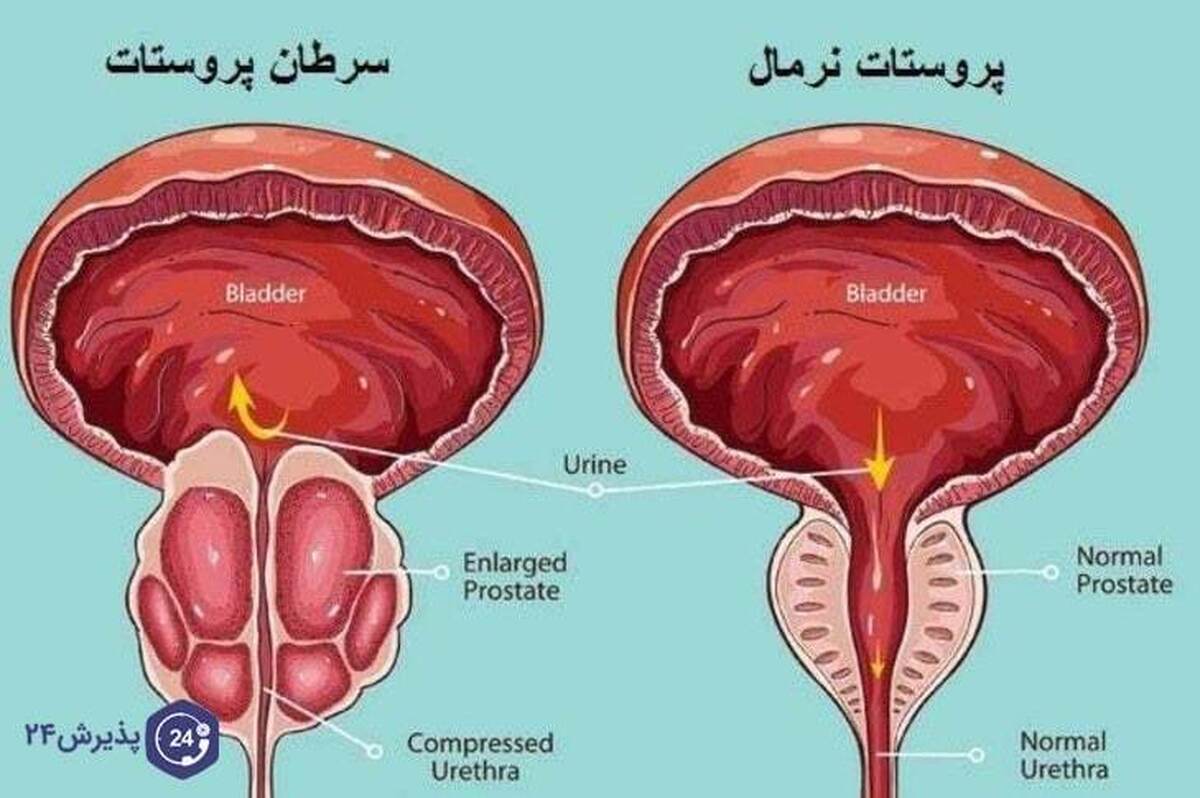 علائم سرطان پروستات بدخیم چیست؟