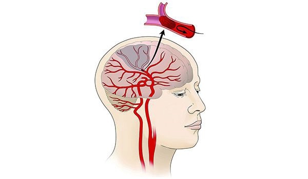 6 نشانه سکته مغزی را بشناسید